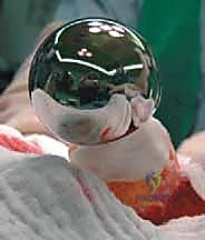 صورة طبية: استبدال سطح مفصل الورك: حل متطور لآلام الورك واستعادة النشاط مع الأستاذ الدكتور محمد هطيف