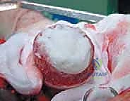 صورة طبية: استبدال سطح مفصل الورك: حل متطور لآلام الورك واستعادة النشاط مع الأستاذ الدكتور محمد هطيف