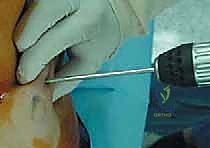 صورة طبية: استبدال سطح مفصل الورك: حل متطور لآلام الورك واستعادة النشاط مع الأستاذ الدكتور محمد هطيف