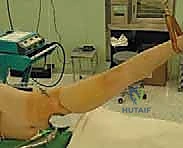 صورة طبية: استبدال سطح مفصل الورك: حل متطور لآلام الورك واستعادة النشاط مع الأستاذ الدكتور محمد هطيف