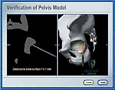 صورة طبية: استبدال سطح مفصل الورك: حل متطور لآلام الورك واستعادة النشاط مع الأستاذ الدكتور محمد هطيف