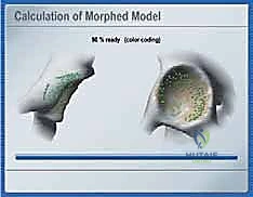 صورة طبية: استبدال سطح مفصل الورك: حل متطور لآلام الورك واستعادة النشاط مع الأستاذ الدكتور محمد هطيف