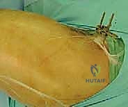 استخدام العكازات في الأيام الأولى