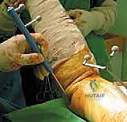 صورة توضيحية لـ استبدال سطح مفصل الورك: حل متطور لآلام الورك واستعادة النشاط مع الأستاذ الدكتور محمد هطيف