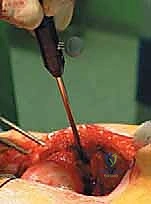 صورة طبية: استبدال سطح مفصل الورك: حل متطور لآلام الورك واستعادة النشاط مع الأستاذ الدكتور محمد هطيف