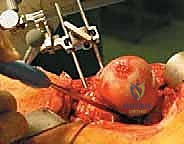 صورة طبية: استبدال سطح مفصل الورك: حل متطور لآلام الورك واستعادة النشاط مع الأستاذ الدكتور محمد هطيف