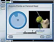 صورة طبية: استبدال سطح مفصل الورك: حل متطور لآلام الورك واستعادة النشاط مع الأستاذ الدكتور محمد هطيف