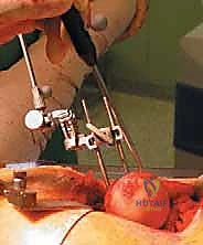 تركيب الغطاء المعدني