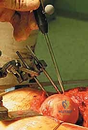 صورة طبية: استبدال سطح مفصل الورك: حل متطور لآلام الورك واستعادة النشاط مع الأستاذ الدكتور محمد هطيف