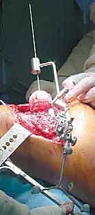 شكل رأس الفخذ بعد التلبيس