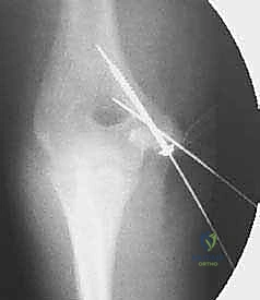 Illustration of fractures of the medial - Dr. Mohammed Hutaif