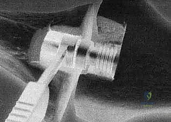 الإصابات الرضية الشديدة التي تستدعي دمج مفصل الركبة