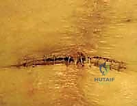 صورة طبية: دمج مفصل الركبة (تثبيت الركبة): الحل الأمثل للحالات المعقدة واستعادة الحركة في صنعاء مع الأستاذ الدكتور محمد هطيف