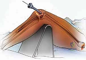 صورة توضيحية لـ دمج مفصل الركبة (تثبيت الركبة): الحل الأمثل للحالات المعقدة واستعادة الحركة في صنعاء مع الأستاذ الدكتور محمد هطيف