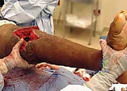 تأثير العدوى المزمنة على مفصل الركبة الصناعي