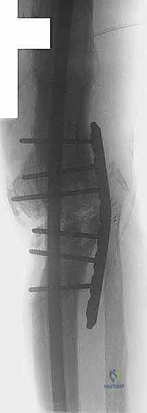 صورة توضيحية لـ دمج مفصل الركبة (تثبيت الركبة): الحل الأمثل للحالات المعقدة واستعادة الحركة في صنعاء مع الأستاذ الدكتور محمد هطيف