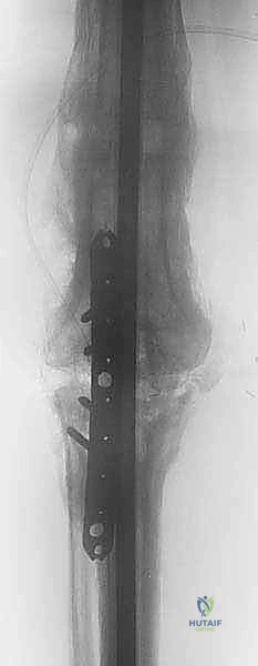 صورة توضيحية لـ دمج مفصل الركبة (تثبيت الركبة): الحل الأمثل للحالات المعقدة واستعادة الحركة في صنعاء مع الأستاذ الدكتور محمد هطيف