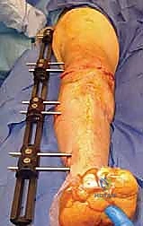 الأعراض الشائعة التي تستدعي تقييم دمج مفصل الركبة