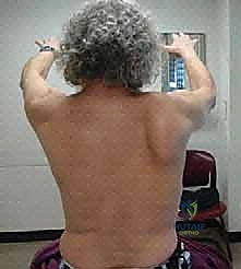 صورة توضيحية لـ نقل العضلة الصدرية الكبرى لعلاج شلل العصب الصدري الطويل (الجناح الكتفي): دليل شامل للمرضى مع الأستاذ الدكتور محمد هطيف