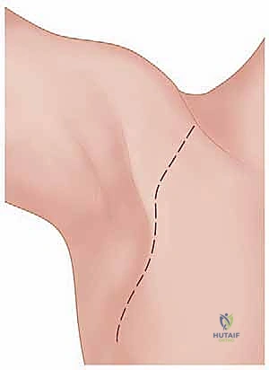 عملية الحصاد الدقيق للرأس القصي للعضلة الصدرية الكبرى