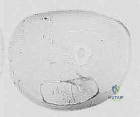 Illustration of hamstring injury proximal hamstring - Dr. Mohammed Hutaif