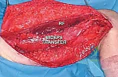 Illustration of superficial femoral artery - Dr. Mohammed Hutaif