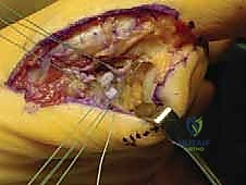 Masterclass: Precision Tibial Sesamoidectomy for Refractory Hallux Pain