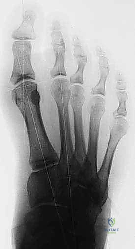 FIG 10 Preoperative A and postoperative B standing radiographs of the foot showing no change in the clinical alignment of the metatarsophalangeal joint after tibial sesamoidectomy
