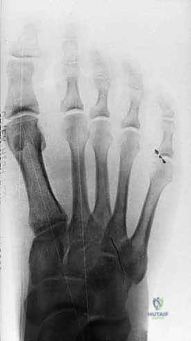 FIG 10 Preoperative A and postoperative B standing radiographs of the foot showing no change in the clinical alignment of the metatarsophalangeal joint after tibial sesamoidectomy