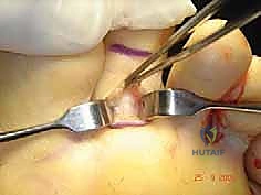 تخطيط الشق الجراحي لعملية نقل الوتر