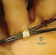 صورة توضيحية لـ عملية نقل الوتر لعلاج إصبع المطرقة المرن: دليل شامل للمرضى مع الأستاذ الدكتور محمد هطيف