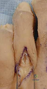 صورة توضيحية لـ عملية نقل الوتر لعلاج إصبع المطرقة المرن: دليل شامل للمرضى مع الأستاذ الدكتور محمد هطيف