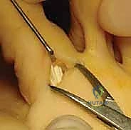 الخيارات غير الجراحية وتأثيرها على ميكانيكية القدم