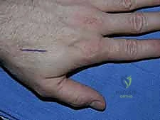 استخدام أسلاك K-wires