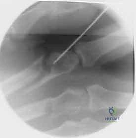 صورة توضيحية لـ كسور عظام اليد المشطية: دليل شامل للعلاج الجراحي مع الأستاذ الدكتور محمد هطيف