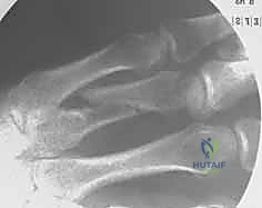 صورة طبية: كسور عظام اليد المشطية: دليل شامل للعلاج الجراحي مع الأستاذ الدكتور محمد هطيف