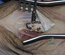 حماية الأوتار والأعصاب