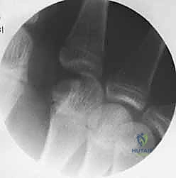 إصابة سحقية معقدة