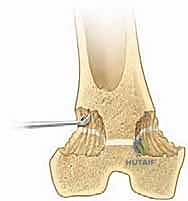 Illustration of third of the physis - Dr. Mohammed Hutaif