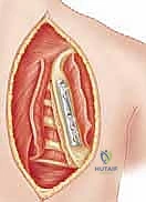 تثبيت الكتف الصدري (Scapulothoracic Arthrodesis): دليل شامل للمرضى مع الأستاذ الدكتور محمد هطيف