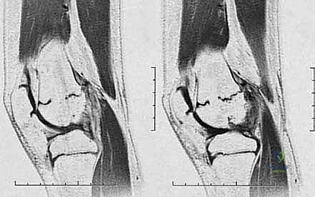 Illustration of physeal bar resection - Dr. Mohammed Hutaif