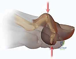 تشريح القدم وتوضيح المفاصل المتأثرة بإصبع القدم المطرقية