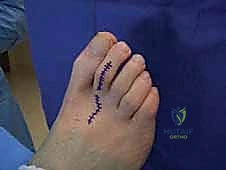 صورة توضيحية لـ إصبع القدم المطرقية دليل شامل للعلاج والتعافي مع الأستاذ الدكتور محمد هطيف في صنعاء