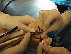 صورة توضيحية لـ إصبع القدم المطرقية دليل شامل للعلاج والتعافي مع الأستاذ الدكتور محمد هطيف في صنعاء