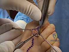 صورة توضح عملية استئصال جزء من رأس السلامية الدانية Arthroplasty