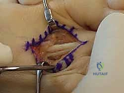 ظهور مسامير القدم والكالو نتيجة الاحتكاك المستمر في إصبع القدم المطرقية