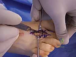 استخدام الوسائد السيليكونية كأحد طرق العلاج التحفظي لتخفيف الاحتكاك