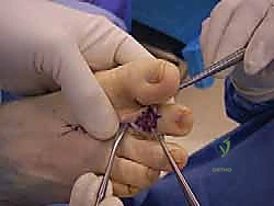 صورة توضيحية لـ إصبع القدم المطرقية دليل شامل للعلاج والتعافي مع الأستاذ الدكتور محمد هطيف في صنعاء