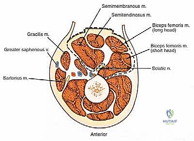 Illustration of posterior thigh resection - Dr. Mohammed Hutaif