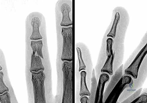رسم توضيحي يوضح الميكانيكا الحيوية وقوى الشد العضلي التي تؤدي إلى انزياح كسور السلاميات